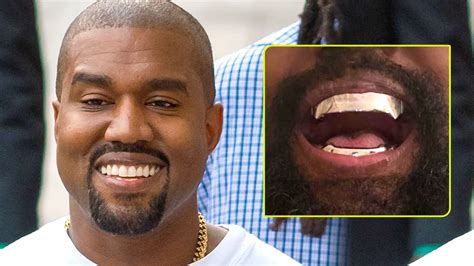 Smile Upgrade: Kanye West Opts for Unique Titanium Dentures Over ...