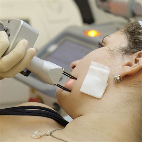 Лазерное удаление бородавок в Ташкенте