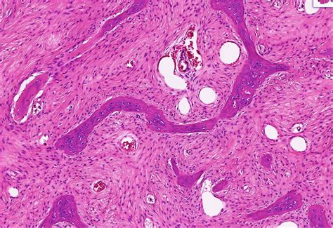 Fibrous Dysplasia Photomicrograph Hematoxylin Eosin Stain Shows