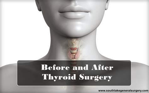 Before And After Thyroid Surgery Dr Valeria Simone Southlake General