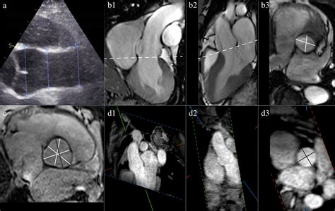 How To Measure The Aorta Using Mri A Practical Guide Hout 2020