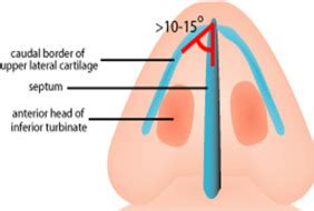 Spreader Graft Placement An Effective Procedure For Alleviation Of