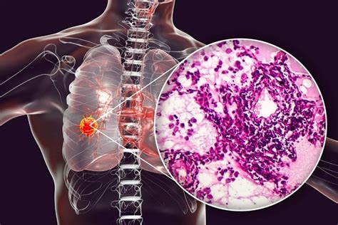 Sotorasib Outperforms Docetaxel In KRAS G12C Mutated NSCLC ASCO 2023