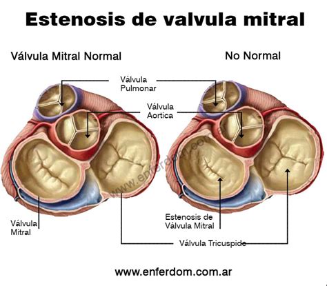 Blog Del Corazon Estenosis Mitral