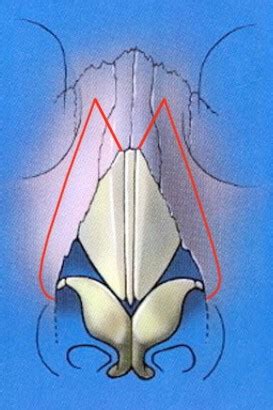 Wide Nasal Bridge Sydney | Low Nasal Dorsum Australia | Open Roof ...