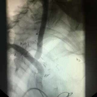 Postoperative Digital Subtraction Angiography Showing A Patent