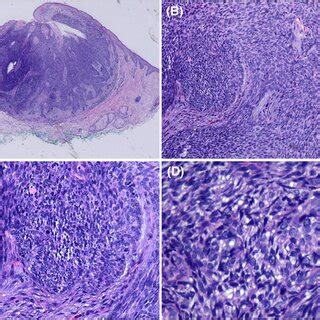 Histopathological Features A A Wellcircumscribed Tumor In The