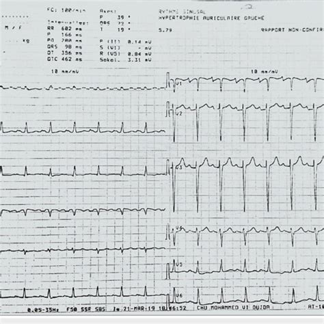 Electrocardiogram Showing Sinus Tachycardia Download Scientific Diagram