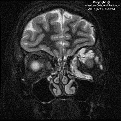 Neuroradiology On the Net: Cavernous hemangioma