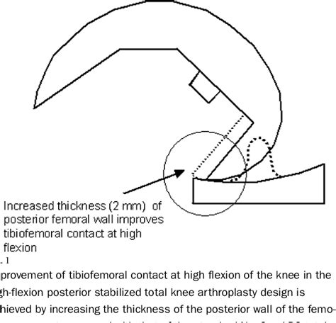 Figure 1 From Knee Kinematics With A High Flexion Posterior Stabilized