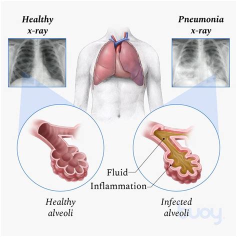 Pneumonia Causes Symptoms Diagnosis Treatment 59 Off