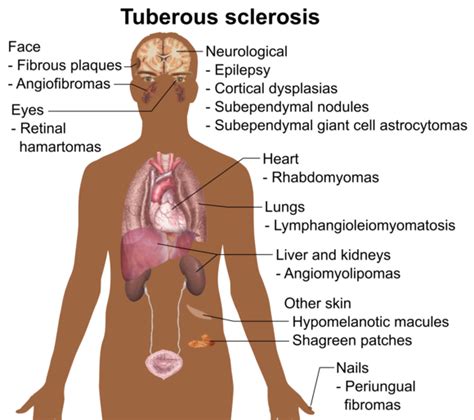 Tuberous sclerosis - Wikipedia