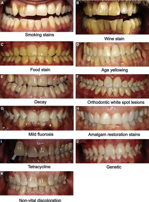 How To Get Rid Of Teeth Stains Between Teeth At Sarah Janes Blog