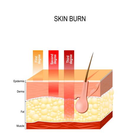 List 94 Pictures Second Degree Burn Healing Stages Pictures Completed