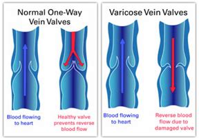 Vein Facts Grace Medical Skin And Vein Centre