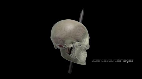 Phineas Gage And His Brain Injury Animation Youtube