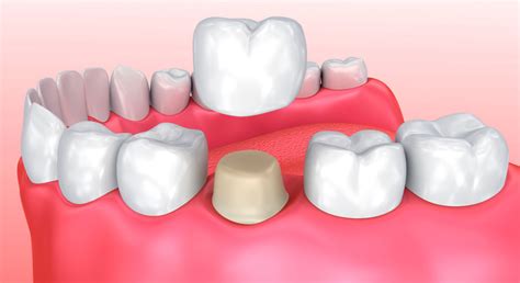 Tratamientos Dentales en Guatemala - GrupoDent