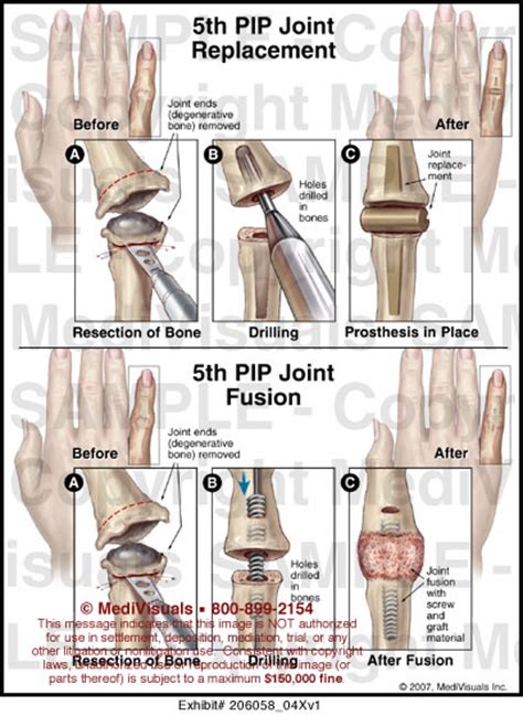 5th PIP Joint Replacement and Fusion Medical Illustration