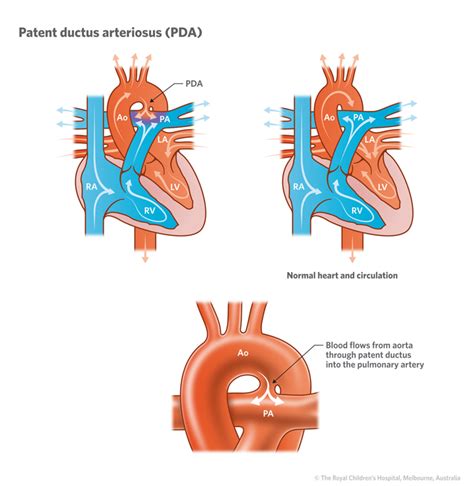 Cardiology Patent Ductus Arteriosus Pda