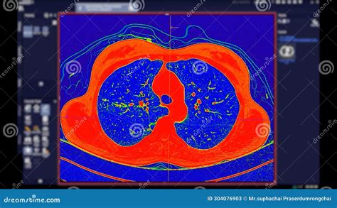 Ct Scan Of Chest Axial View In Color Mode For Diagnostic Pulmonary