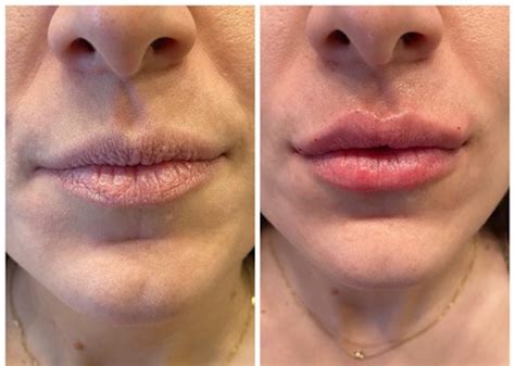 Doll Lips Filler Lipstutorial Org