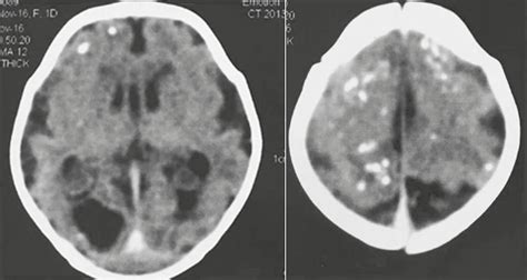 Scielo Brasil Differential Diagnosis Of Pathological Intracranial