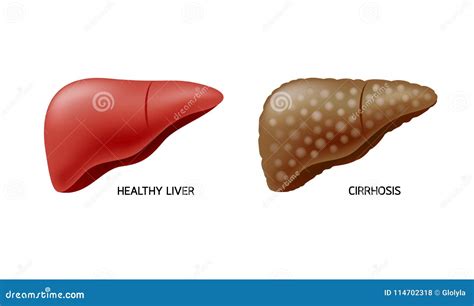 Cirrosis Del Higado Vs Higado Sano