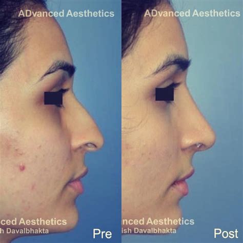 Recovery After Rhinoplasty Surgery In Pune