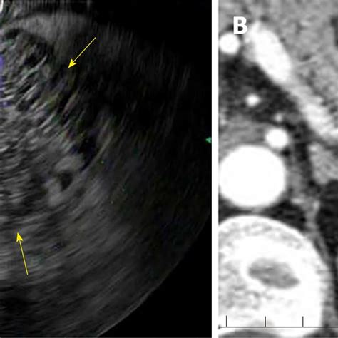 Endoscopic Ultrasound Honeycomb Appearance A Endoscopic Ultrasound Download Scientific