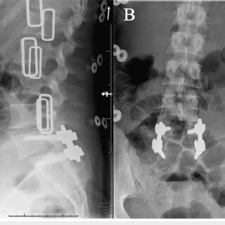 Post Operative Anteroposterior And Lateral Lumbar Spine Xrays A