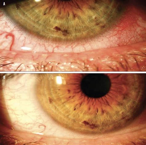 Ethambutol Toxicity Eye Screening Clipart