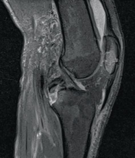 MRI Fat Saturated T2 Weighted Lateral View Showing A Displaced