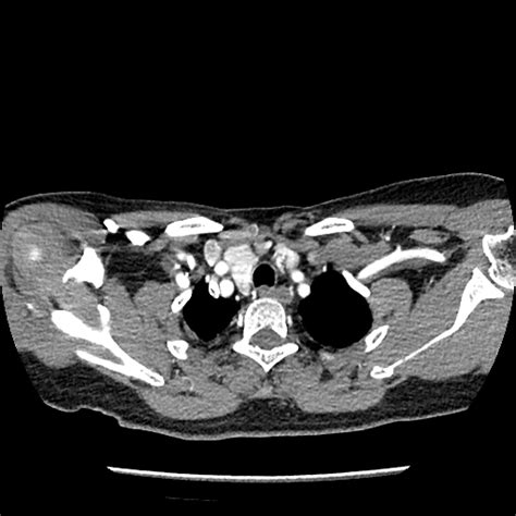 Parathyroid Adenoma With Polar Vessel Sign Image