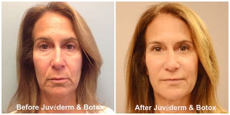 Put Your Best Face Forward This Holiday Season With Botox And Fillers