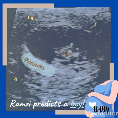 Ramzi Theory Accurate Gender Prediction Early Ultrasound