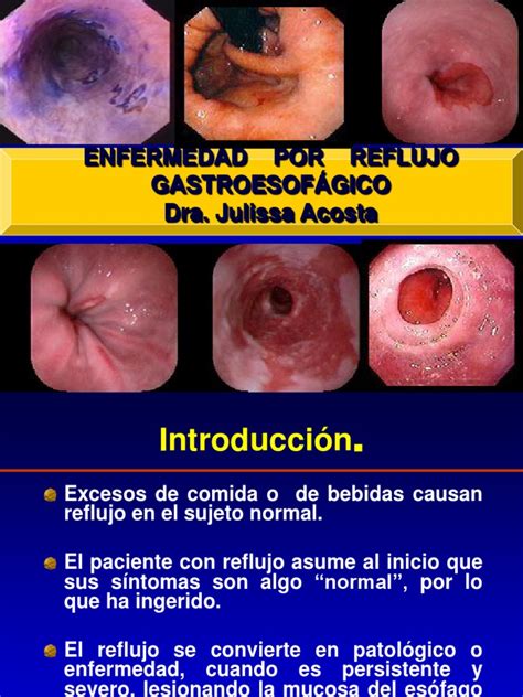 Enfermedad Por Reflujo Gastroesofágico Factores Protectores Y