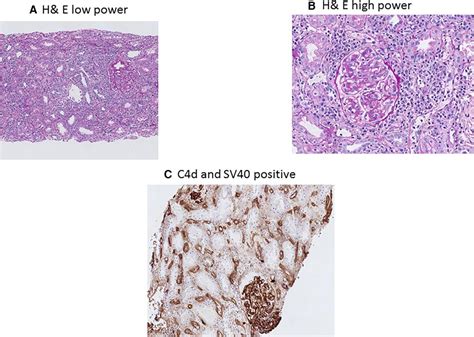 Frontiers BK Polyomavirus Infection More Than 50 Years And Still A