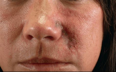 Too Much Filler In Nasolabial Folds An Absolute Guide Blushastic