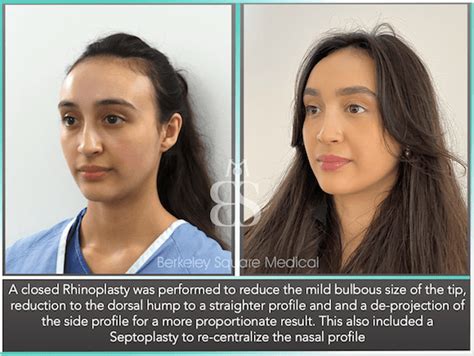 Best Rhinoplasty Surgeon London Top Rhinoplasty Surgeons Uk