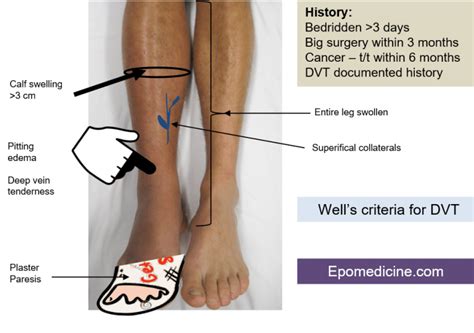 Well’s Criteria For Dvt With Mnemonic Epomedicine