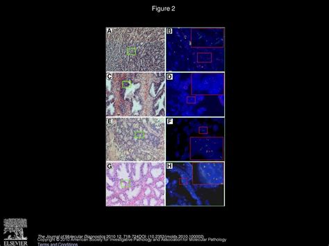 Detection Of TMPRSS2 ETS Fusions By A Multiprobe Fluorescence In Situ