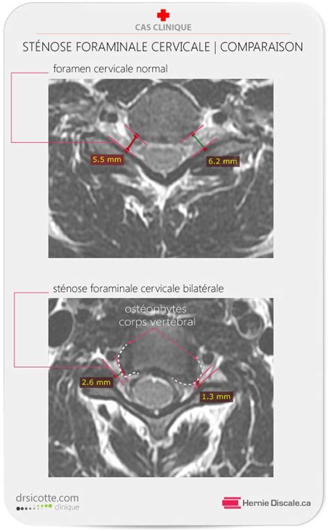 Sympt Mes St Nose Foraminale Cervicale Hot Sex Picture