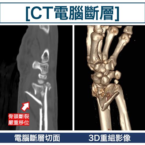 Distal Radius Fracture