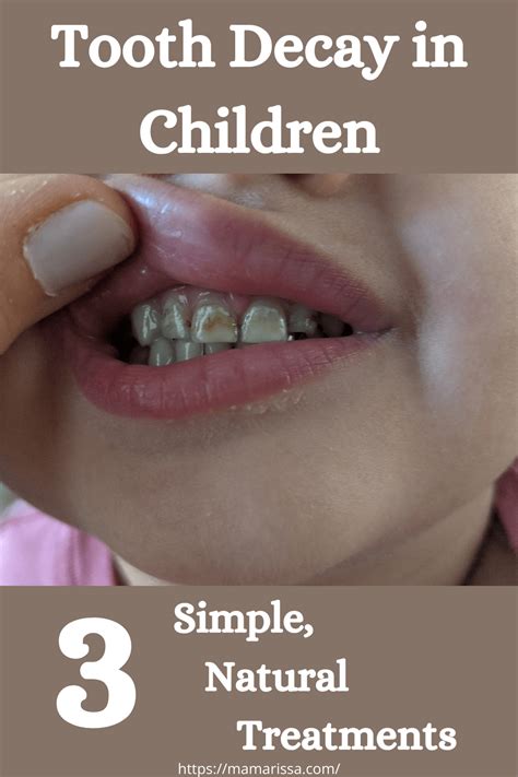 Tooth Decay In Children 3 Simple Natural Treatments • Mama Rissa