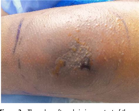 Figure From Primary Cutaneous Mucormycosis In An Immunocompetent