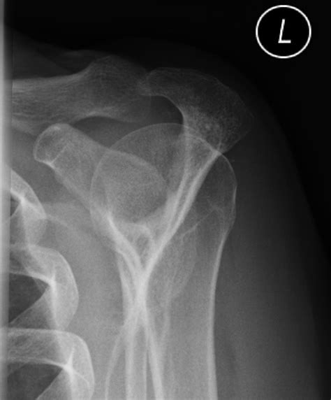 Acromial Types Pacs