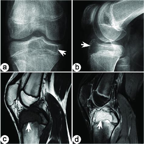 Typical Imaging Features Of Chondroblastoma Arrow Denotes Lesion A