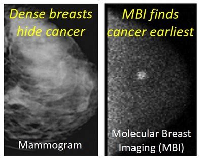 Smartbreast Acquires Molecular Breast Imaging Assets From Dilon