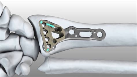 Acu Loc 2 Volar Distal Radius Surgical Technique 720p Youtube