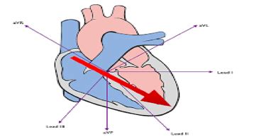 Ecg Axis Enlargement Hypertrophy Flashcards Quizlet